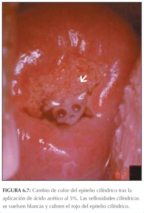 La Colposcopia Y El Tratamiento De La Neoplasia Intraepitelial Cervical