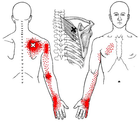 1024 x 860 jpeg 111 кб. Pain management using Trigger Point Therapy - PalmLeaf Massage