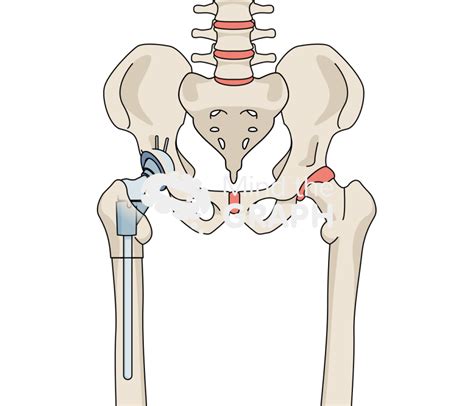Subtrochanteric Osteotomy Tha Bone Full