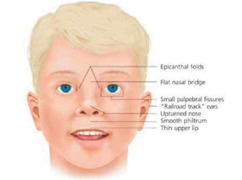 Characteristic Facial Features In A Child With Fetal Alcohol Syndrome