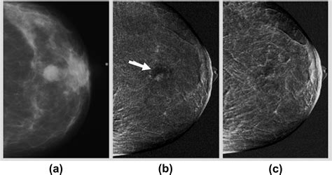 Contrast Enhanced Mammography Techniques Current Results And