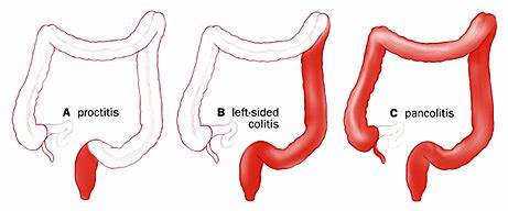 Диета Колит - dietaol Картинка - Диета Колит - dietaol