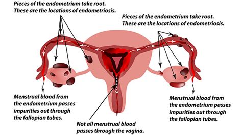 Als endometriose wird das vorkommen von endometriumähnlichem gewebe außerhalb der gebärmutterhöhle (cavum uteri) bezeichnet. Endometriose og ønsket om barn | Prøver | Babyverden.no