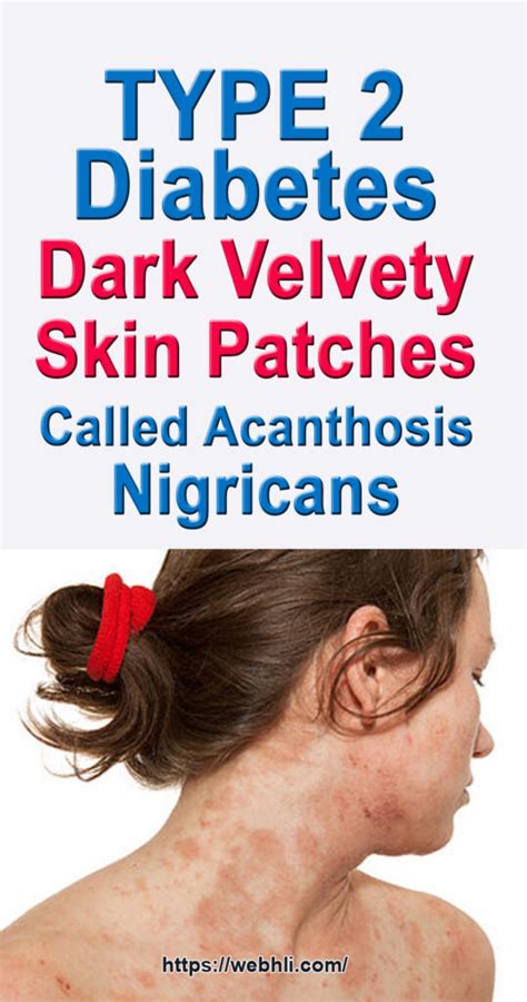 Type 2 Diabetes Dark Velvety Skin Patches Called Acanthosis Nigricans