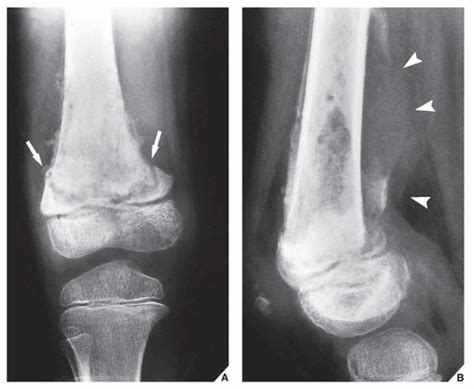 Osteomyelitis Infectious Arthritis And Soft Tissue Infections