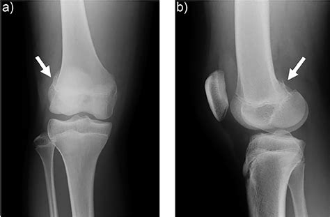Medial Femoral Condyle Fracture