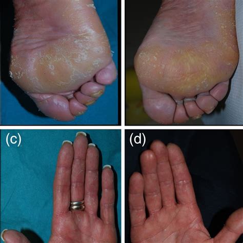 A And B Keratoderma And Diffuse Scaling Of Both Palms And Soles