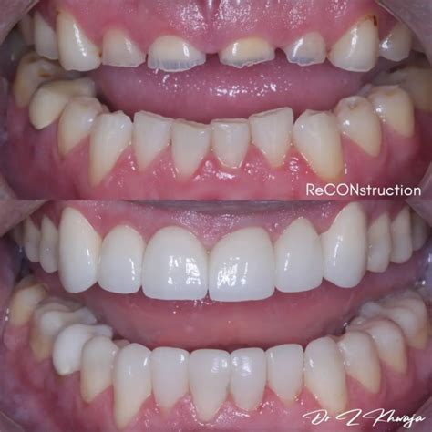 Bite The Habit With Bruxism Treatment Smile Wide With A Confident Vibe