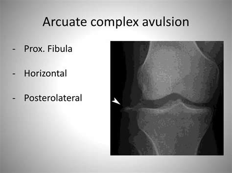 Ppt Approach To The Knee Radiograph For Bony Injuries Powerpoint