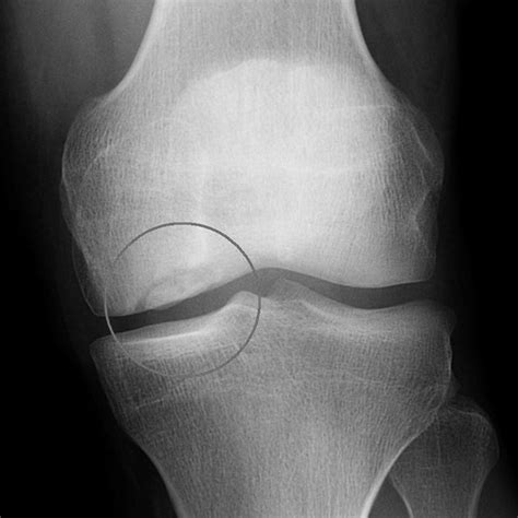 Anteroposterior Radiograph Of Knee With A Medial Femoral Condyle