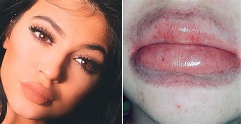 10 Celeb Trends As Dumb As Kylie Jenners Lip Challenge