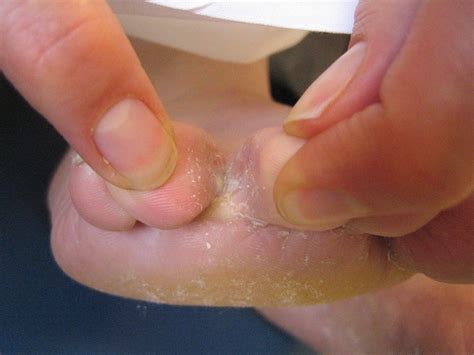 Types And Symptoms Of Foot Fungal Infection Athletes Foot Treatment