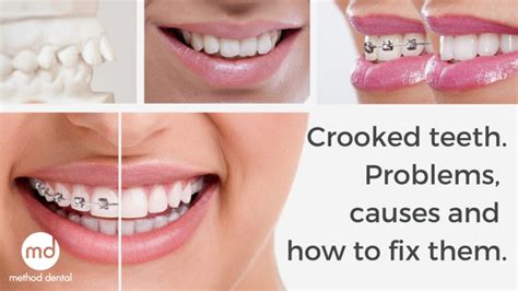 Crooked Teeth Causes Problems And How To Fix Them Method Dental