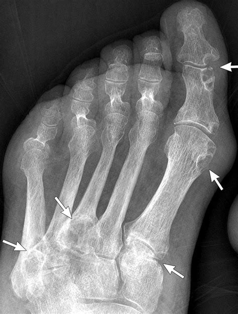 Gout Anteroposterior Foot Radiograph Shows Multiple Punched Out