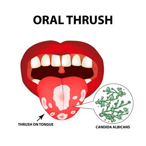 What Is Oral Thrush Acorn Dentistry For Kids