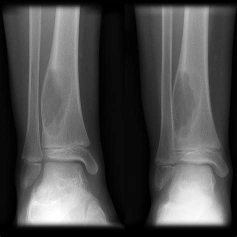 Aneurysmal bone cyst | Image | Radiopaedia.org