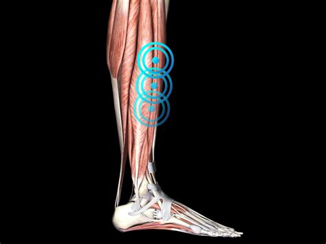 Medial Tibial Stress Syndrome Ems Dolorclast®