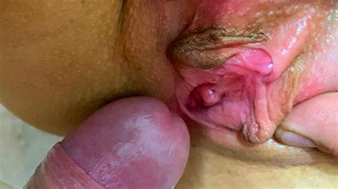 Tympanic Membrane Pictures Hot Sex Picture
