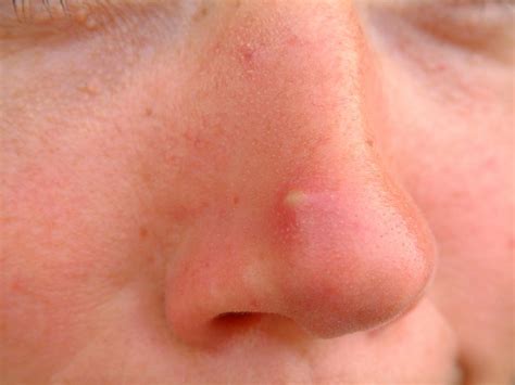 Pimple On Nose Causes How To Get Rid Of Big Cystic