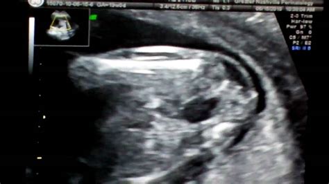 6th Ultrasound Visit 6152010 The Sex Is Revealed Pt1 Youtube