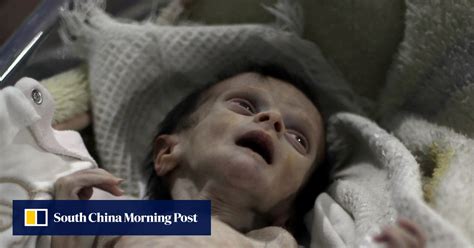 Heartbreaking Images Of Starving Syrian Baby Sahar Close To Death