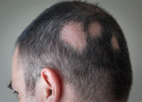 Bald Patches Embarrassing Problems