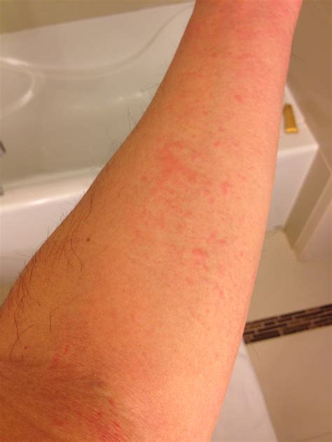 I Have Small Red Spots Like Hives Above Wrist Forearms Side