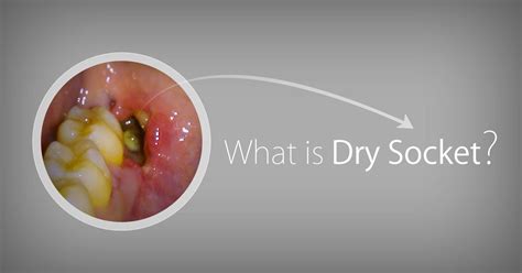 What Is A Dry Socket Dry Socket Emergency Dental Care Dental Health