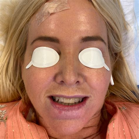 Skin Cancer My Experience With Photodynamic Therapy Pdt Styling You