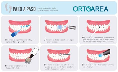 ¿quieres Saber Cómo Se Colocan Los Brackets Blog Clínica Kaizen