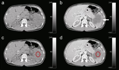 Prognostic Value Of Tumor Necrosis At Ct In Diffuse Large B Cell