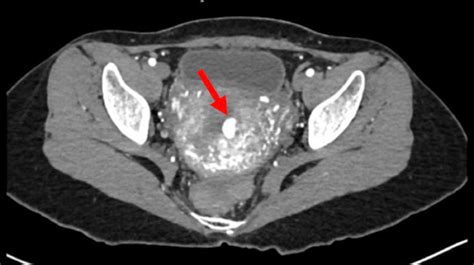 A Rare Case Of Multiple Uterine Artery Pseudoaneurysms After