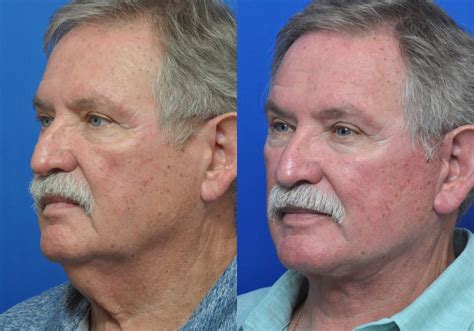 Why Plastic Surgery Is Important Garcia Institute - vrogue.co