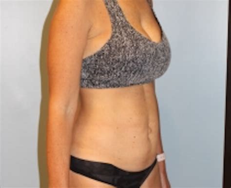 Abdominoplasty Tummy Tuck Before And After Photos Las Vegas