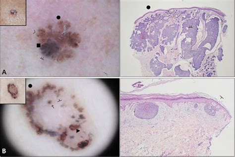 Non Aggressive Types Of Basal Cell Carcinoma A Nodular Type B