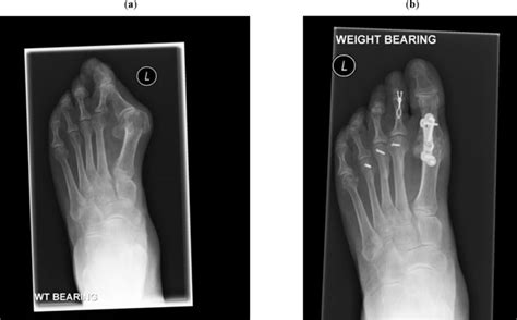 Surgical Management Of The Forefoot In Patients With Rheumatoid