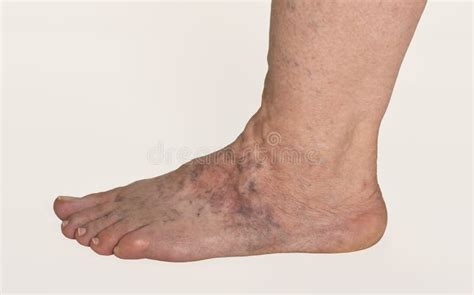Varicose Veins Stock Image Image Of Veins Artery Foot 26847345