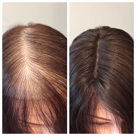 Also, i understand how to style my thin hair which over a long time i had neglected. nutrition | Alternative Hair Solutions