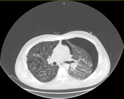 Pulmonary Langerhans Cell Histiocytosis Radiology Case Radiopaedia