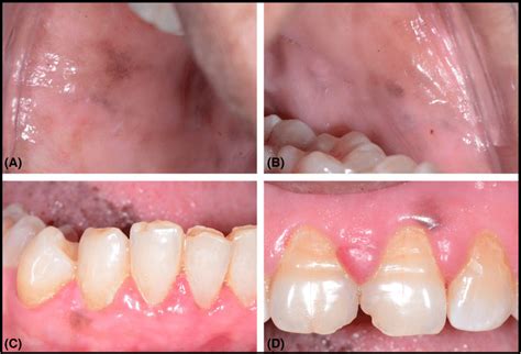 Intraoral Hyperpigmentation A Right Buccal Mucosa B Left Buccal