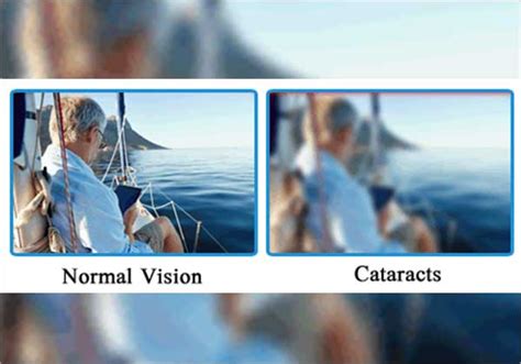 Blurred Vision After Cataract Surgery Treatment Amrit Hospital