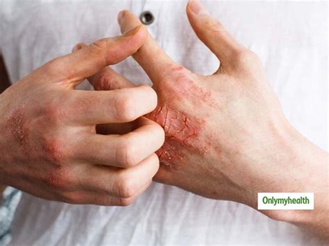 5 Common Adult Skin Problems In Hindi। 5 आम वयस्क त्वचा की समस्याएं