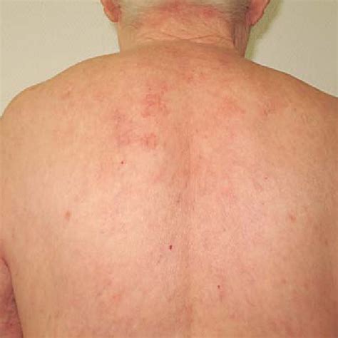 Follicular Papules And Confluent Erythematous Scaly Plaques With Only
