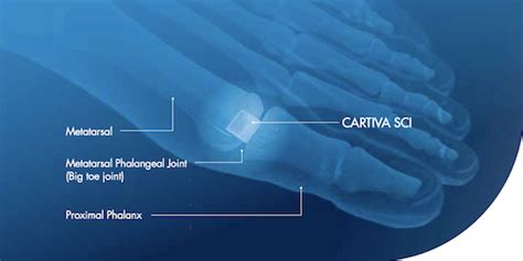 Cartiva® Synthetic Cartilage Implant San Mateo Podiatry Group