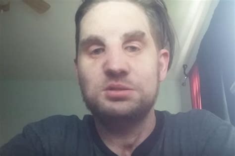 Mitch Hunter Speaks To Reddit About His Full Facial Transplant Daily Star