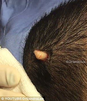 Animal horns form around a centrally located bone, while cutaneous horns, including giant cutaneous horns, do not. Video shows Dr Pimple Popper squeeze a 'horn-like' cyst ...