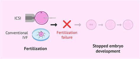 What Is Fertilization Failure