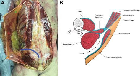 Composite Flap At Lumbar Level A Cadaver Dissection Latissimus Dorsi