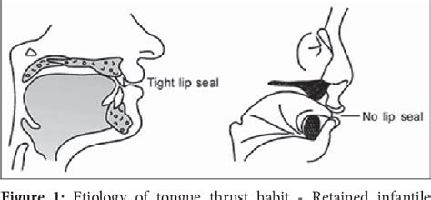 Tongue Thrusting Habit A Review Semantic Scholar