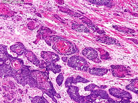 Esophageal Squamous Cell Carcinoma Histology